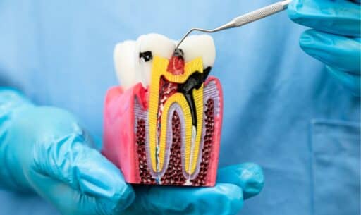 Rotary Endodontics—A Modern Approach to Root Canal Treatment