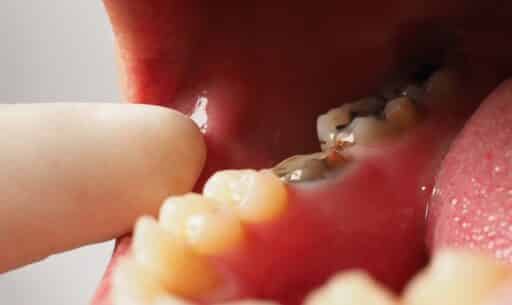 Treating a Tooth with an Abscess