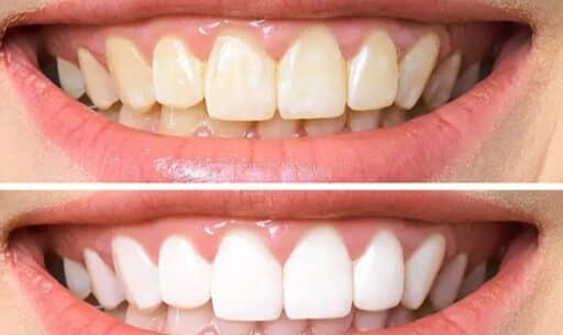 Teeth Whitening Safety: What Dentists Want You to Know