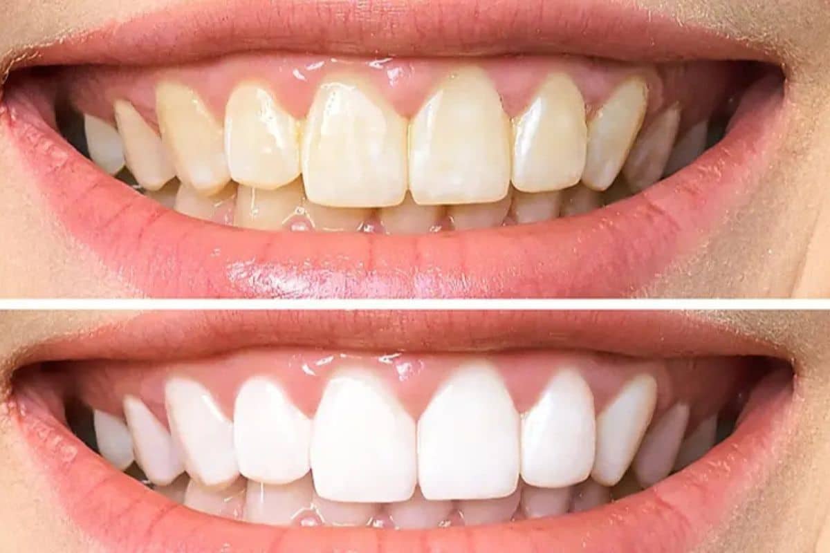 Teeth Whitening Safety: What Dentists Want You to Know