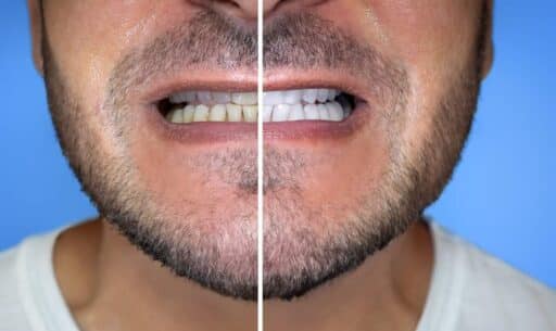 Achieving a Natural Smile | How White Should You Whiten Your Teeth?