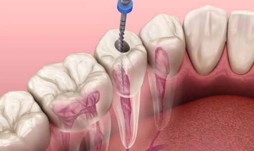 Root Canal Pain Relief What Patients Should Know About Modern Treatment