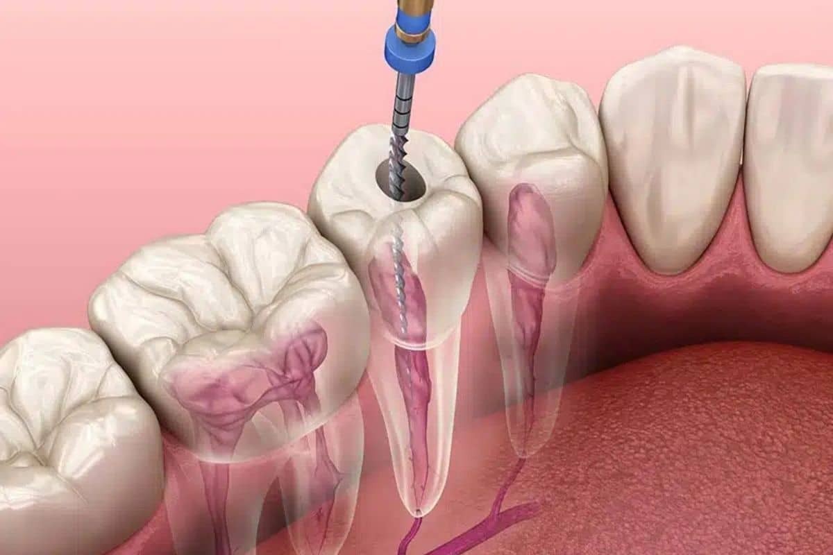 3D dental illustration showing root canal treatment procedure with endodontic file entering tooth canal structure.