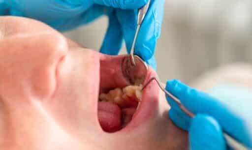 Why You Should Never Ignore a Cavity for Fast Treatment