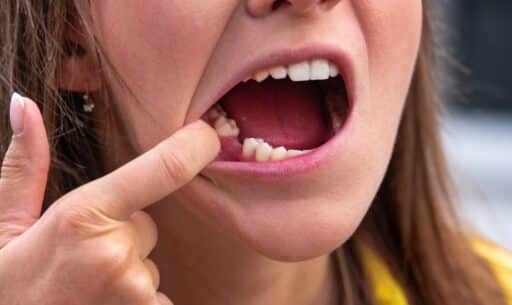 Dental Implant Solutions for Missing Teeth