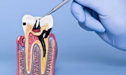 How Dentists Treat Infected Dental Pulp-Root Canal & Beyond