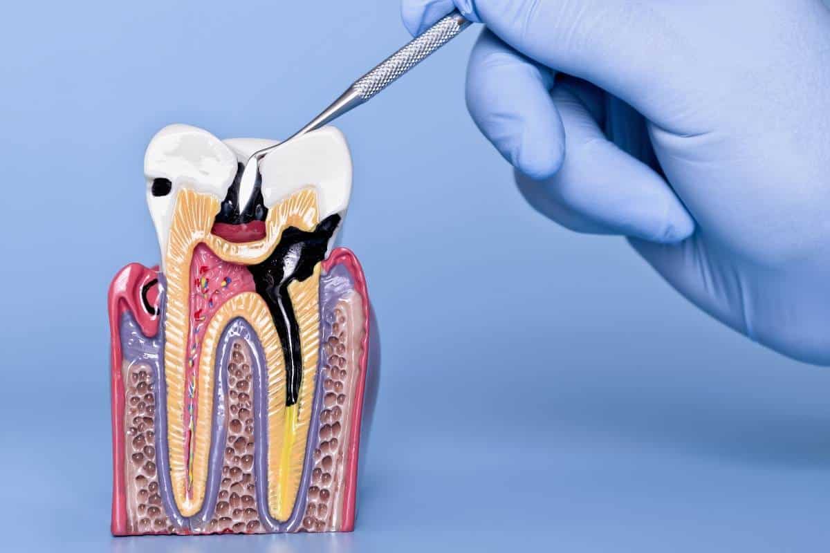 How Dentists Treat Infected Dental Pulp-Root Canal & Beyond