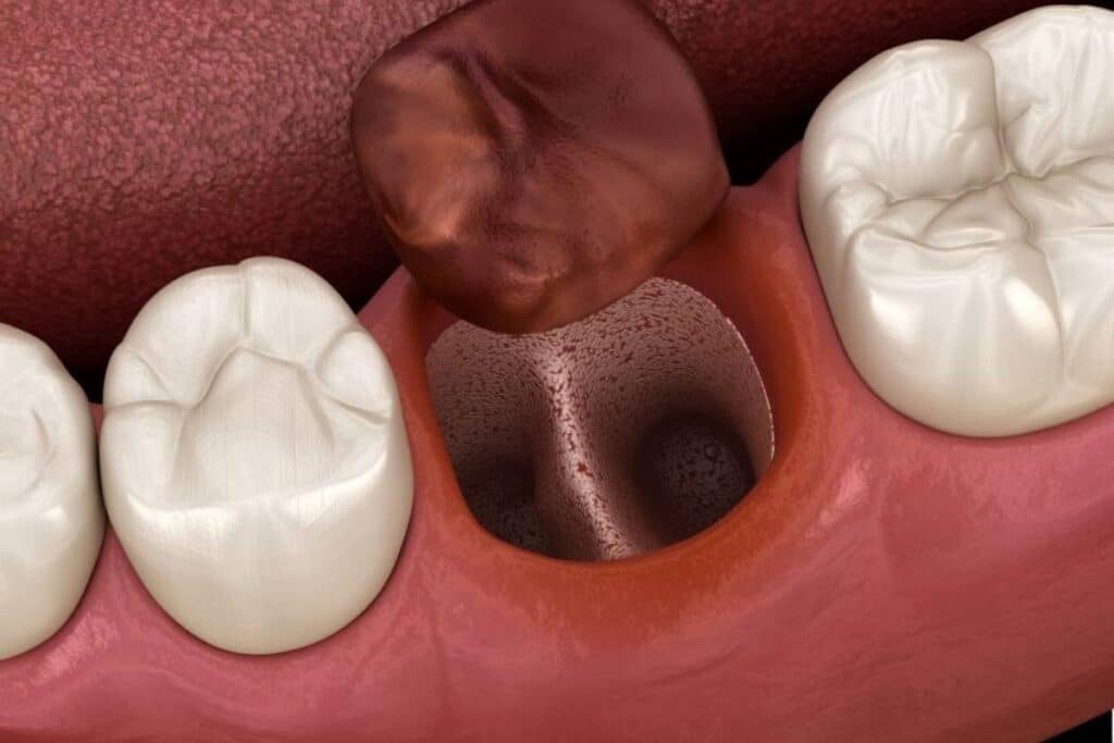 Dry Socket After Tooth Extraction? 5 Symptoms Need a Dentist