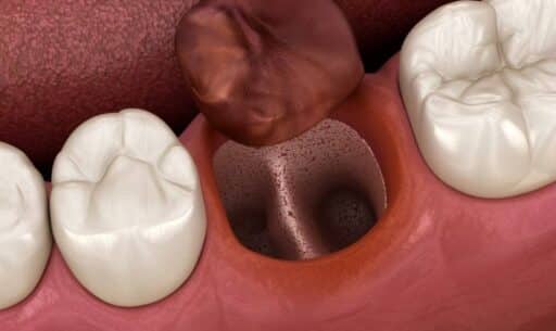 Top 5 Warning Signs of Dry Socket