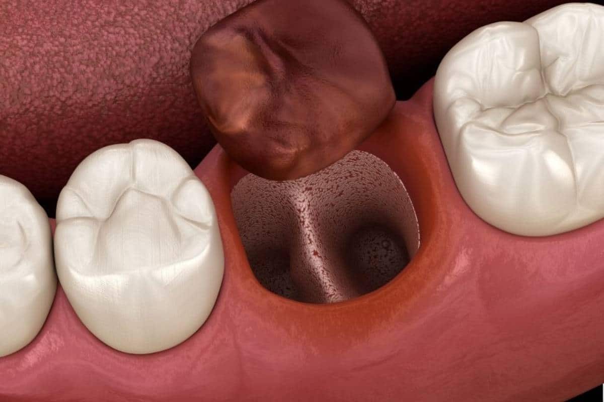 Top 5 Warning Signs of Dry Socket
