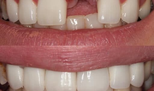 Modern Dentistry’s Leading Solution: Dental Implants