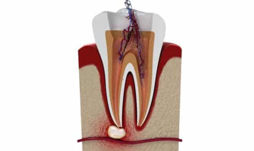 Warning Signs After a Root Canal | Long-Term Health Concerns