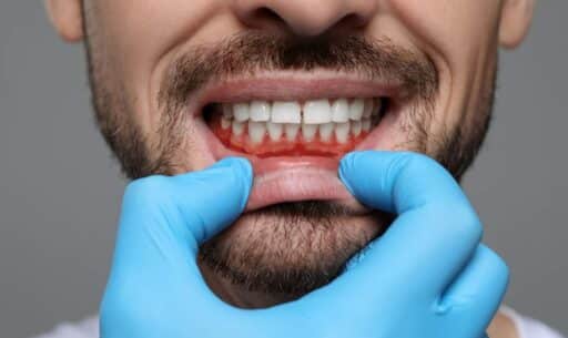 Patient receiving periodontal maintenance cleaning