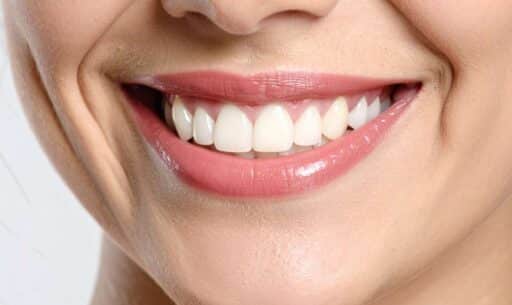 Close-up of white spots on teeth, early signs of cavities in Lake Worth, FL
