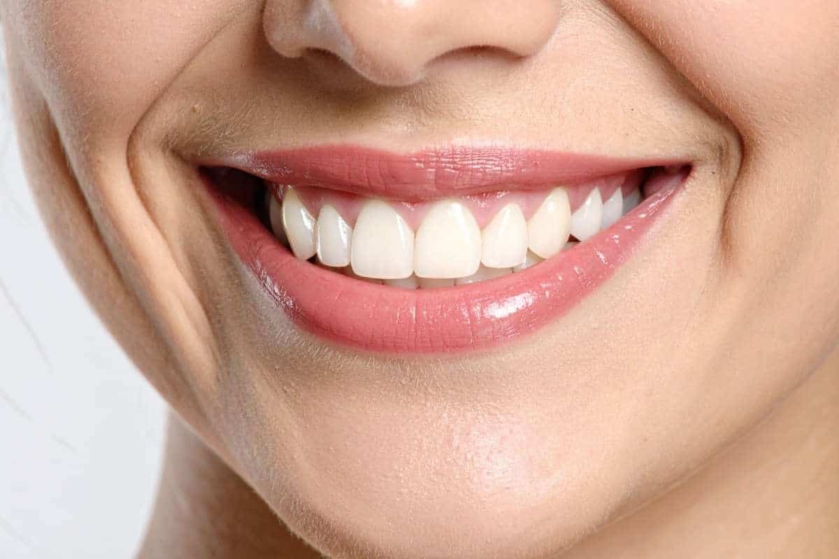 Close-up of white spots on teeth, early signs of cavities in Lake Worth, FL