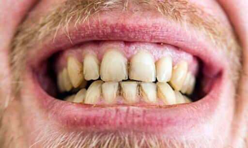Plaque: What Is It and How to Get Rid of It