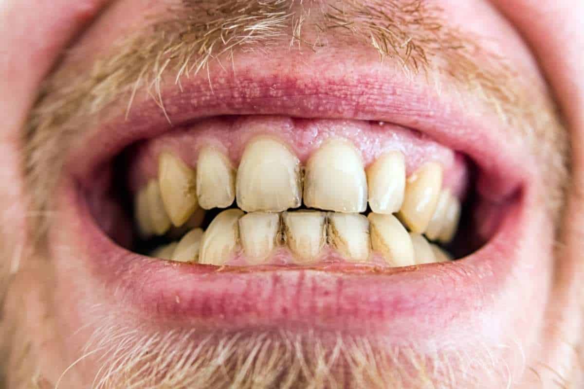 Plaque: What Is It and How to Get Rid of It