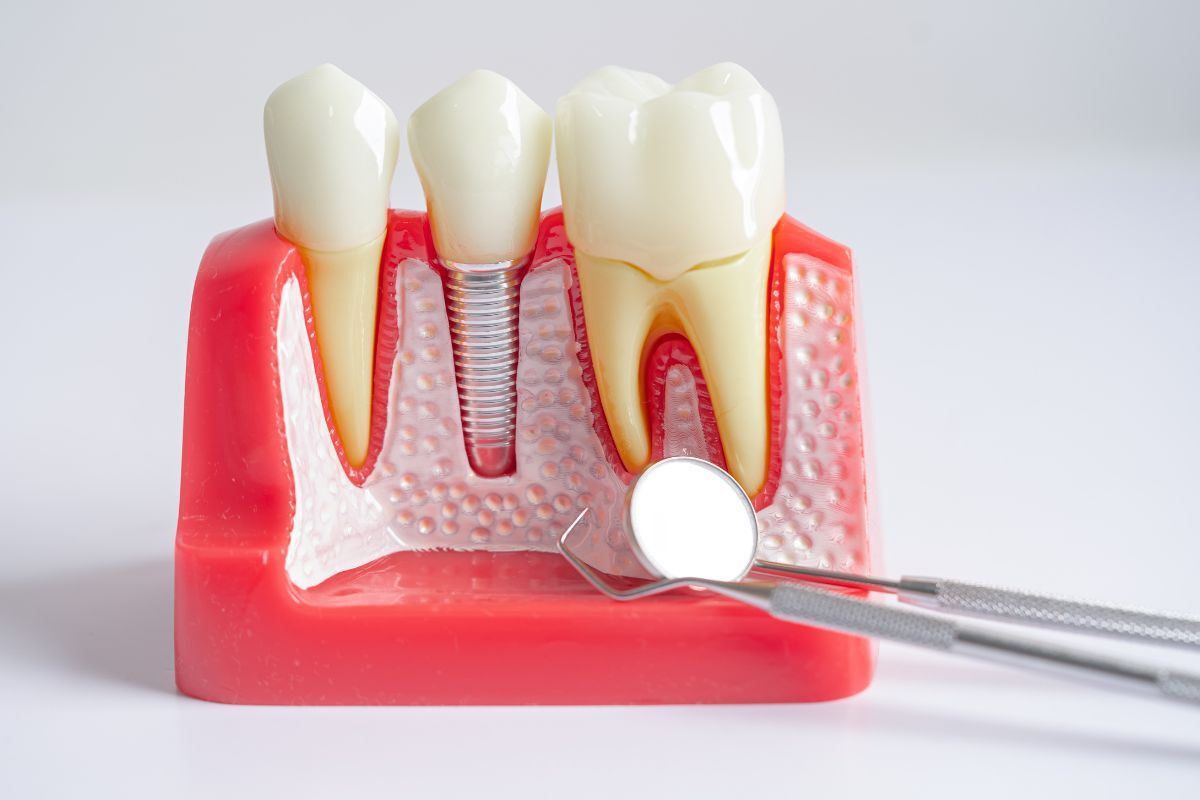 Dental implant model showing tooth replacement with metal implant post and crown between natural teeth.