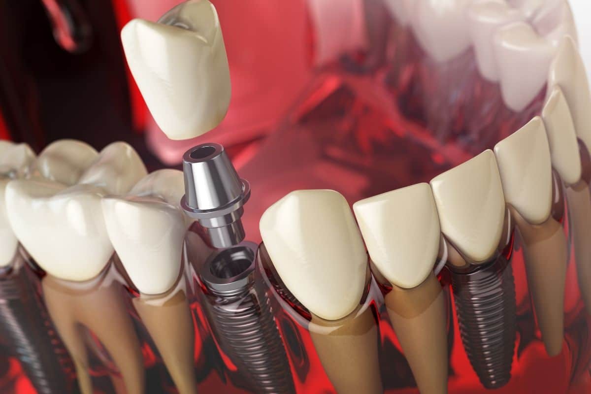 3D dental implant illustration showing tooth replacement with crown and implant posts in jaw.