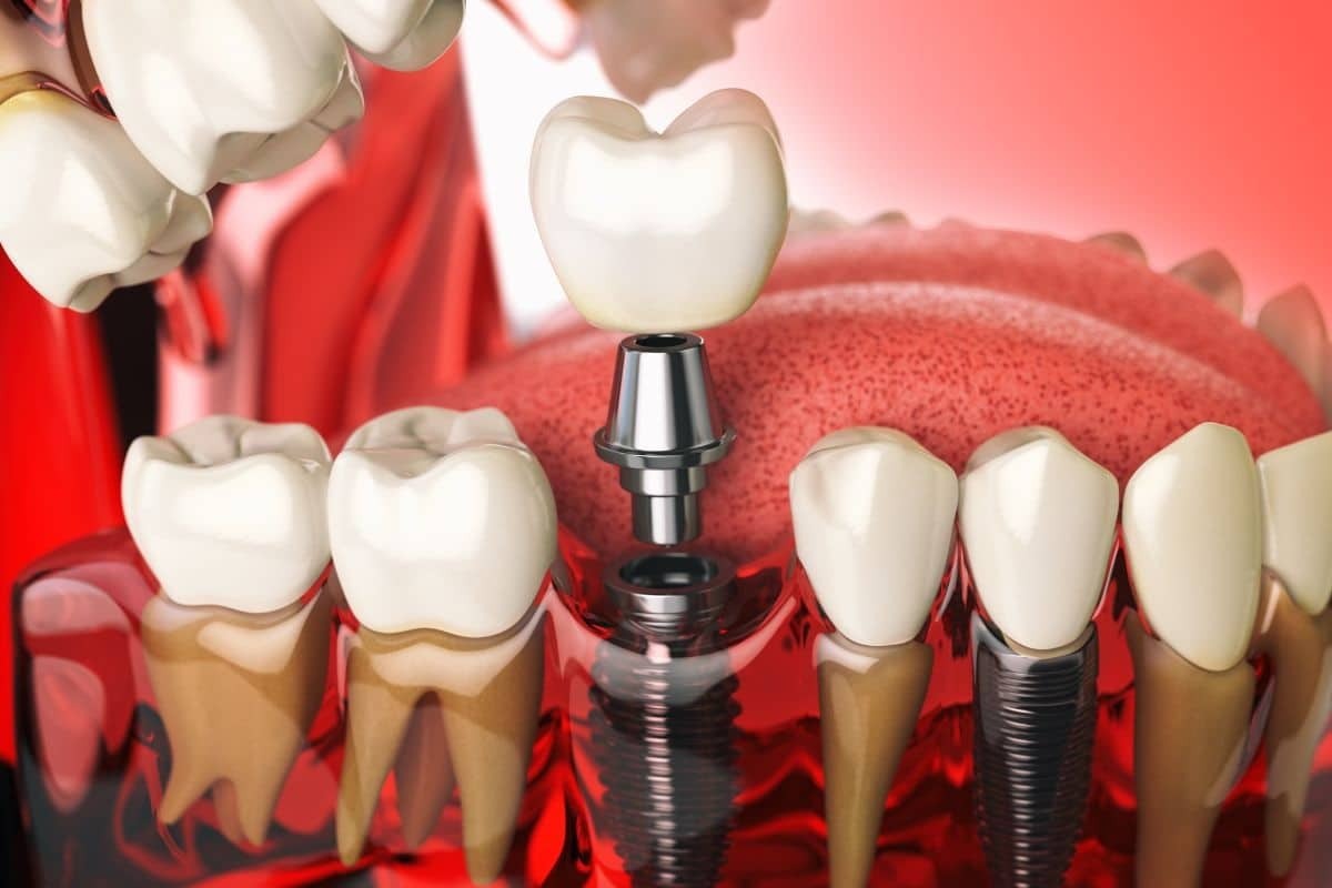 Dental implant illustration showing tooth replacement with crown, abutment, and implant fixture alongside natural teeth.